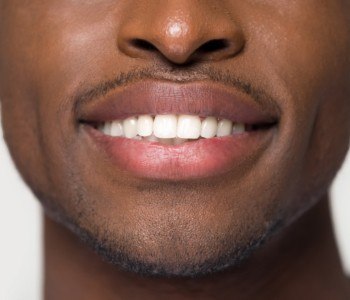 Closeup of perfected smile after Invisalign