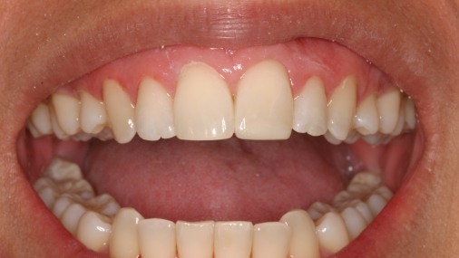 Aligned top teeth after orthodontics