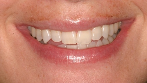 Imperfectly aligned smile before dental treatment