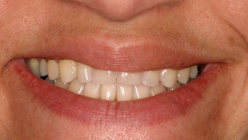 Front top teeth that are discolored and short