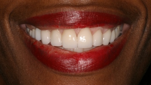 Gap between front teeth closed