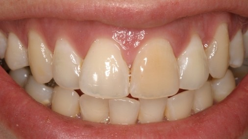Closeup of discolored smile before teeth whitening