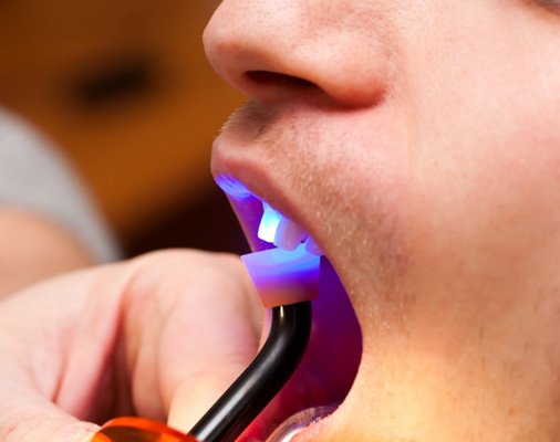 a person getting dental bonding with a UV light in their mouth