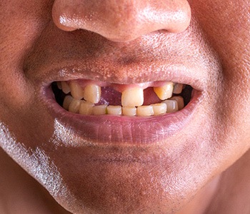 A closeup of a man with missing teeth