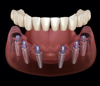 Animated smile with dental implant retained denture
