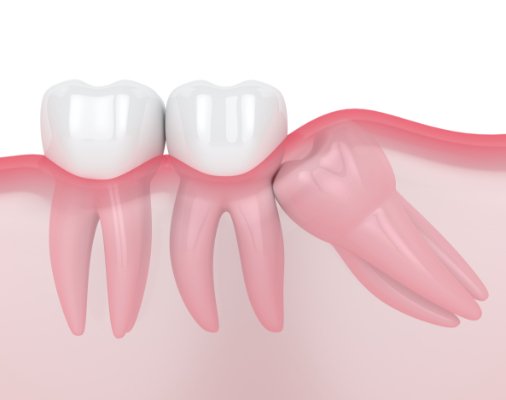 Animated smile with impacted wisdom tooth