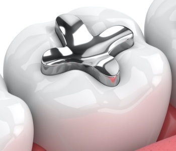 Animated smile with silver amalgam filling