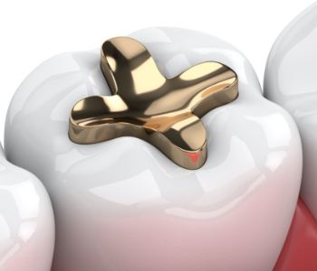 Animated smile with gold filling