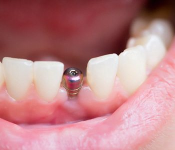 closeup of dental implant in patients mouth