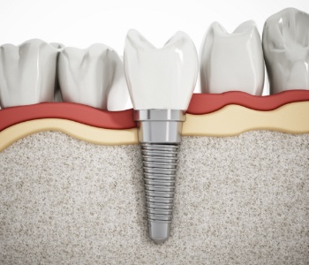 Animated dental implant supported dental crown