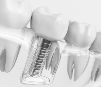 Model smile with dental implant supported dental crown