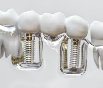 Model smile with dental implant supported fixed bridge