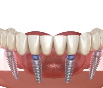 Animated dental implant supported denture