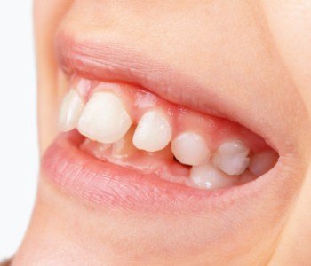 Smile with gapped teeth before orthodontics