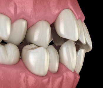 Smile with improper bite alignment before orthodontics