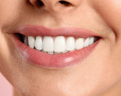 Closeup of flawless smile after makeover