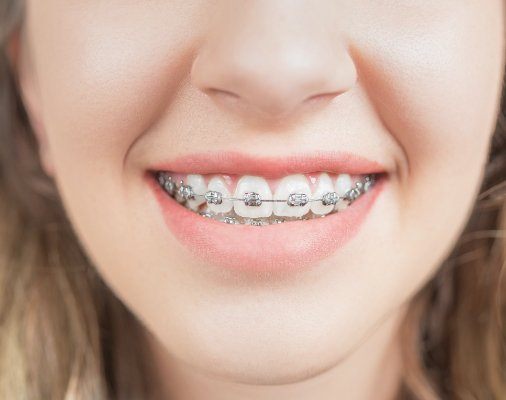 Closeup of smile with traditional braces