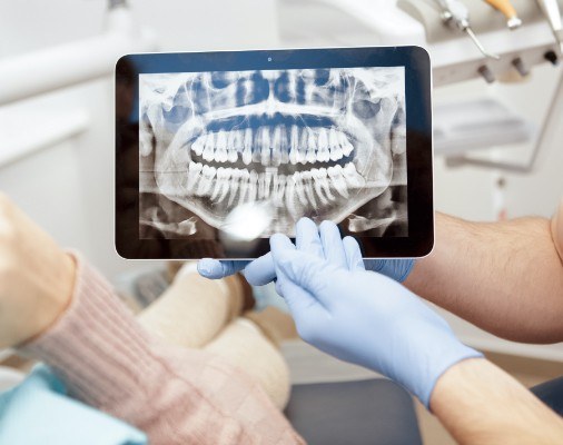 X-ray of smile in need of scaling and root planing periodontal therapy