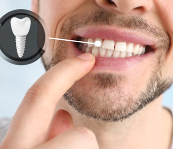 A man pointing out his newly-implanted tooth