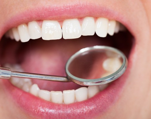 Dentist examining a smile after tooth colored filling