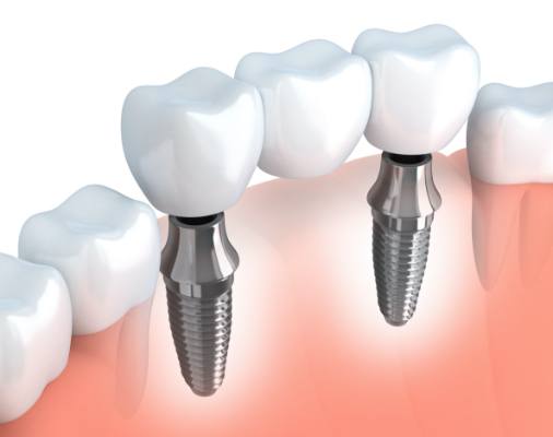 Animated smile with dental implant supported fixed bridge restorative dentistry