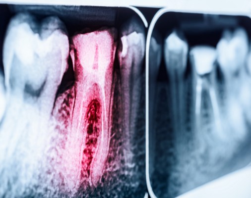 X-ray of a tooth in need of root canal therapy