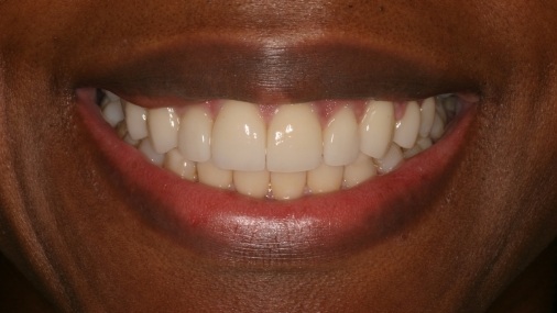 Healthy smile after full mouth reconstruction