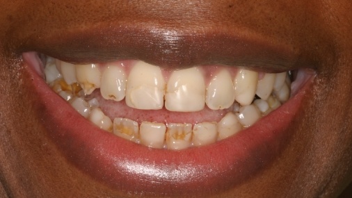 Decayed teeth before full mouth reconstruction