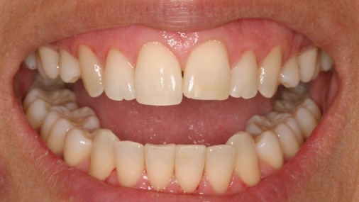 Overlapping top teeth before orthodontics