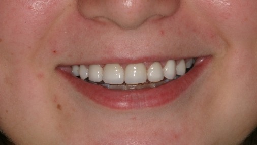 Smile after chipped tooth is repaired