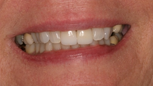 Closeup of healthy bright smile after dental treatment