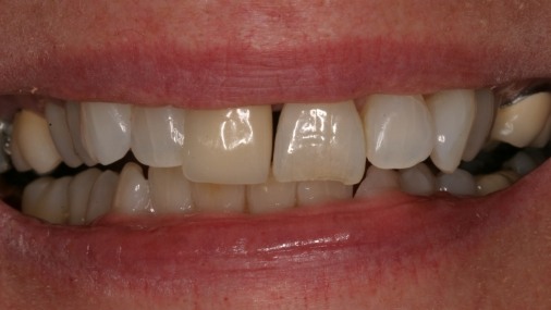 Closeup of discolored smile before dental treatment