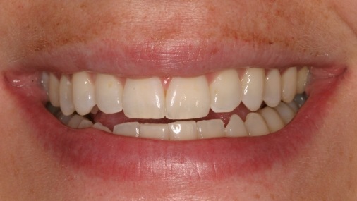 Perfectly aligned smile after dental treatment