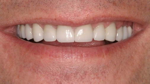 Brilliant white smile after cosmetic dentistry