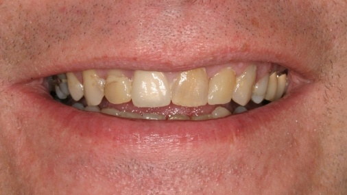 Severely discolored teeth before cosmetic dentistry