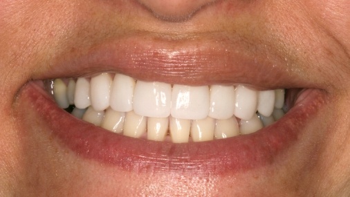 Front top teeth corrected with dentistry