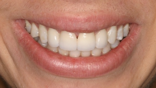 Brilliant smile after teeth whitening