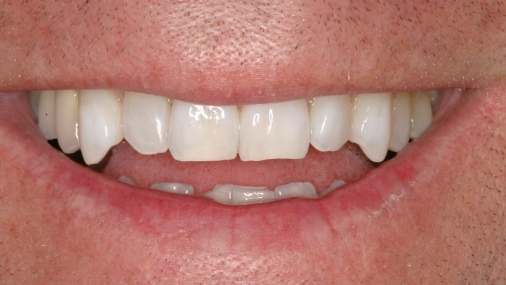 Teeth of uneven sizes before dental treatment