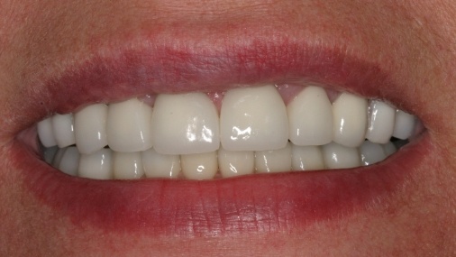 Flawless healthy smile after dental treatment
