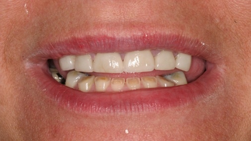 Worn and damaged smile before dental treatment