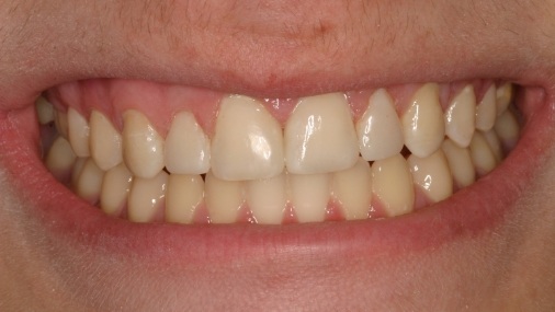 Perfectly aligned smile after orthodontics