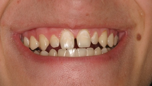 Unevenly spaced teeth before orthodontics
