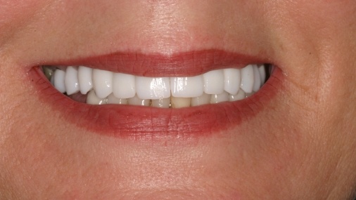 Bright healthy smile after treatment
