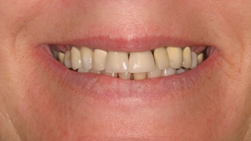 Yellowed and discolored smile before treatment