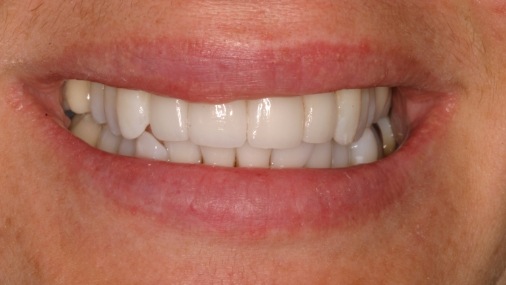 Bright white and healthy smile