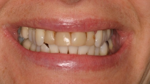 Smile with yellowed top teeth