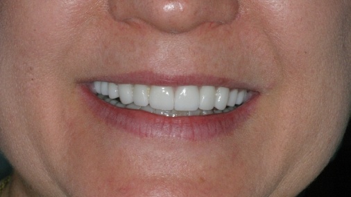 Full and  bright smile after dental restoration