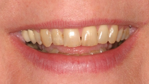 Worn and yellowed smile before dental restoration