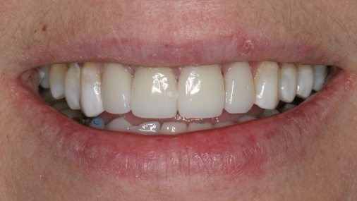Closeup of bright smile after dental treatment