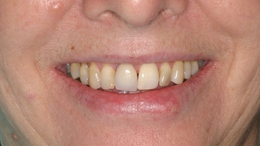 Closeup of yellow smile before dental treatment
